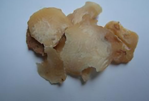 青春痘爆发该如何对证调理